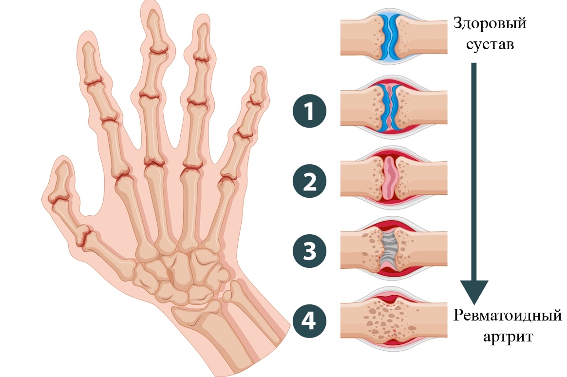 Болит сустав на руке запястья. Сустав. Ревматоидный артрит психосоматика. Фунготерапия артрит.